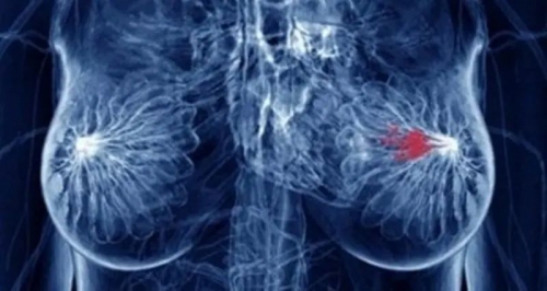 人工智能如何用于对抗乳腺癌