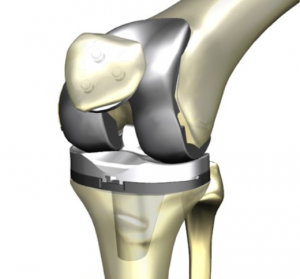 科仪邦恩 膝关节产品