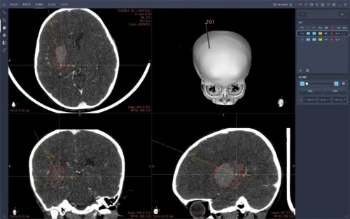 医疗动态 ‖ 市一院神经外科手术机器人，助力精准医疗